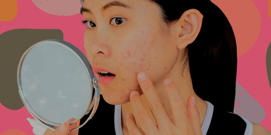 Targeted Solutions for Acne-Prone Skin: Achieving Clear, Healthy Skin